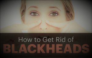 How to get rid of blackheads