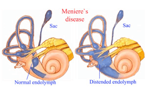 Meniere’s disease