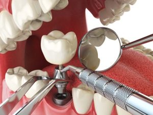 Dental Bone Grafting