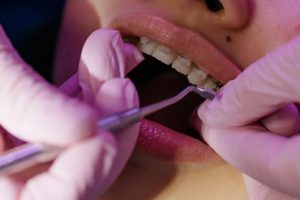 Invisalign Braces: All Questions Answered