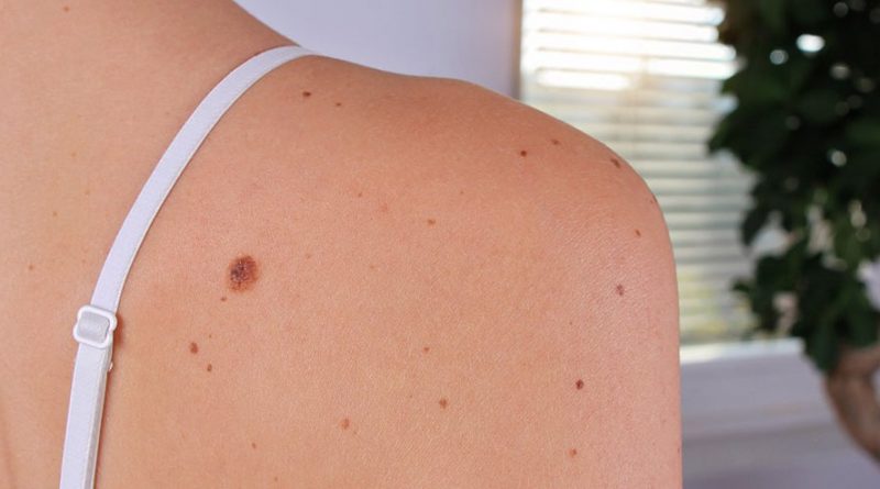 How to Get Rid of Skin Tags at Home: 8 Natural Remedies