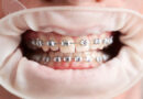 Straightening Smiles in Petts Wood: The Benefits of Orthodontic Treatment