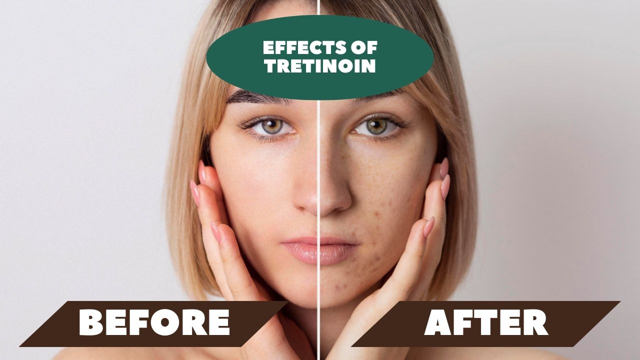 Effects of Tretinoin Before and After
